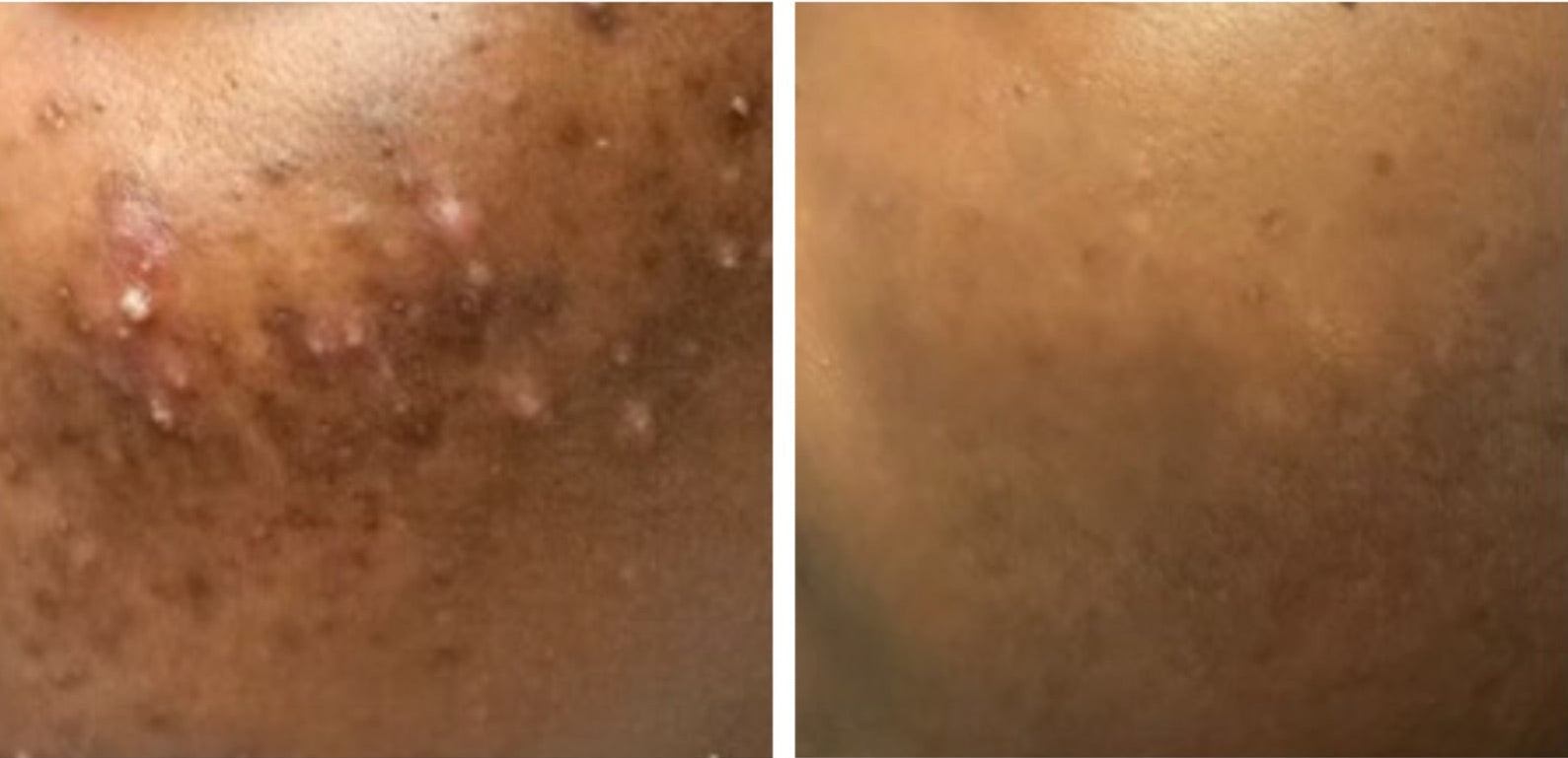Advertisement for a retinol cream with before and after skin condition images on a white background.