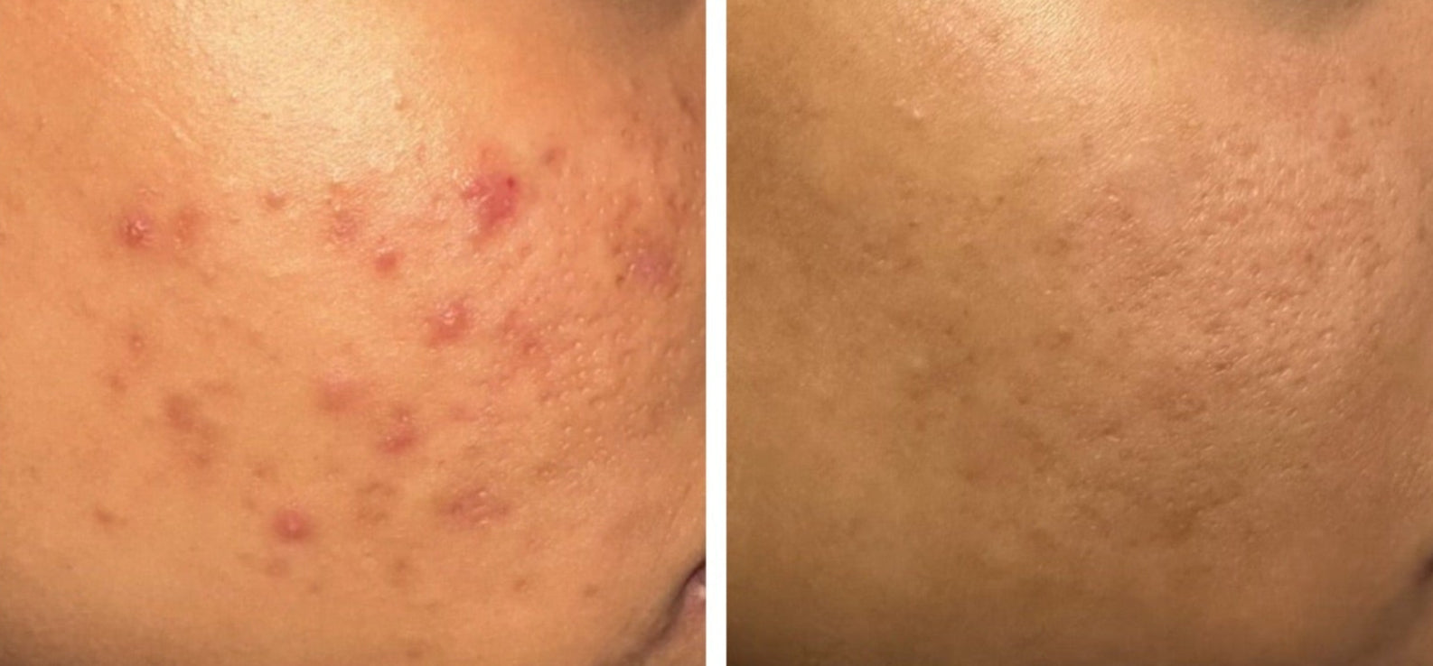 Advertisement for a retinol cream with before and after skin comparison on a white background.